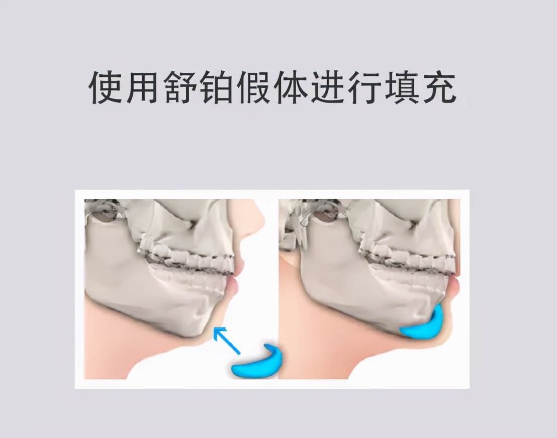 假体垫下巴后会出现位移变形吗？