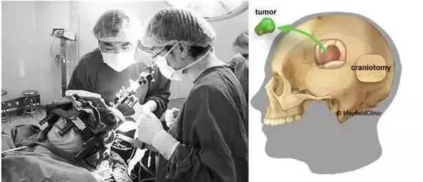 脑胶质瘤患者的疾病知识问答,脑胶质瘤权威知识