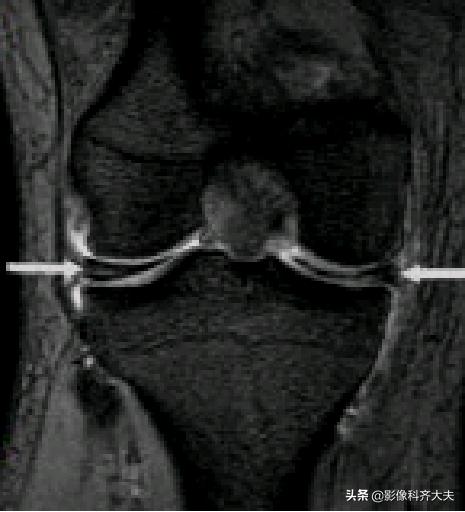 膝关节半月板损伤的磁共振,膝关节半月板病变的mri诊断与鉴别