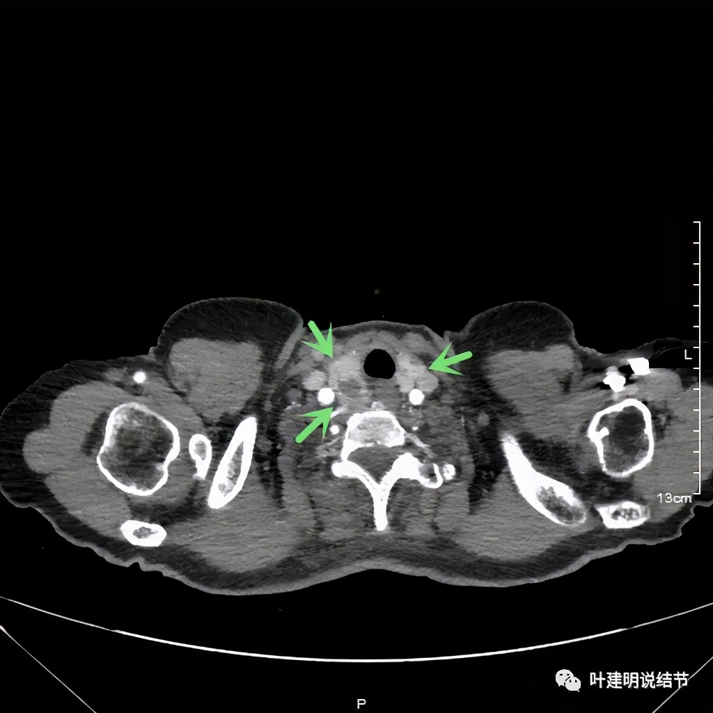 胸部高分辨ct检查注意事项,胸部ct扫描有没有危害