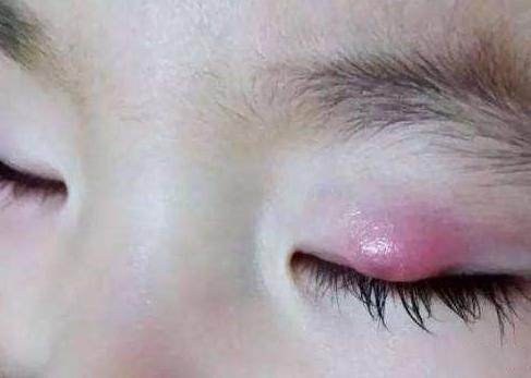 3岁娃错把502胶当成眼药水,2岁宝宝误把蚊香液放嘴巴怎么办