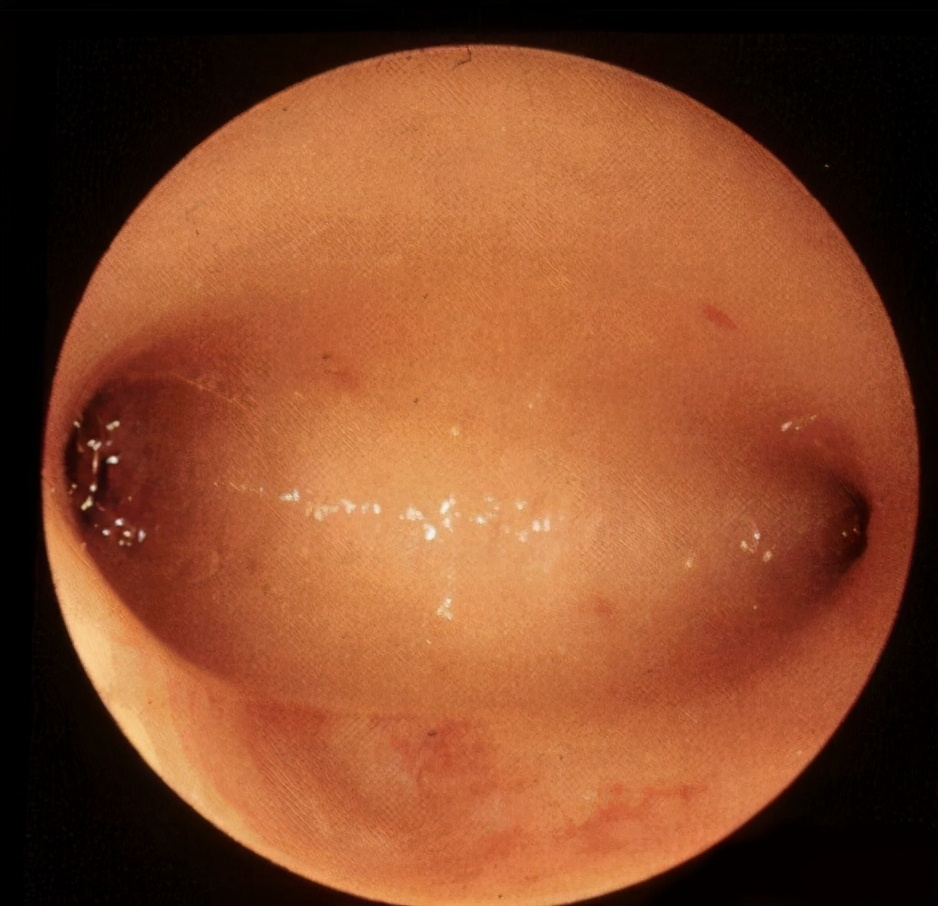 月经量少和流产刮宫有关系吗,月经量少和流产有关吗