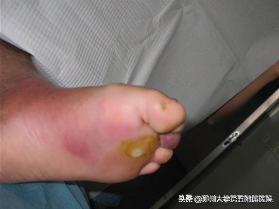 老茧疼痛怎么去除,去除手部老茧