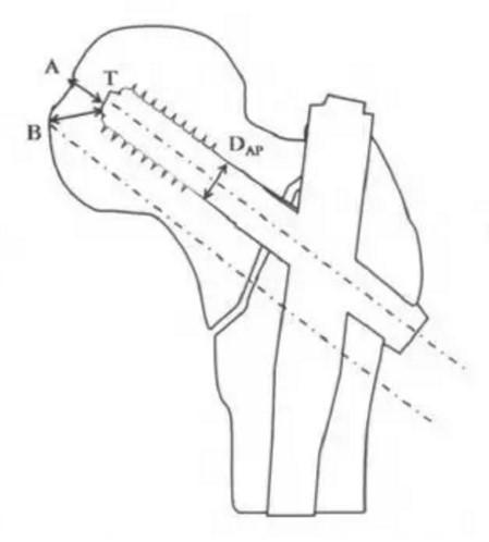 髋部骨折危害大老年人摔伤要重视,髋部骨折的最简单方法