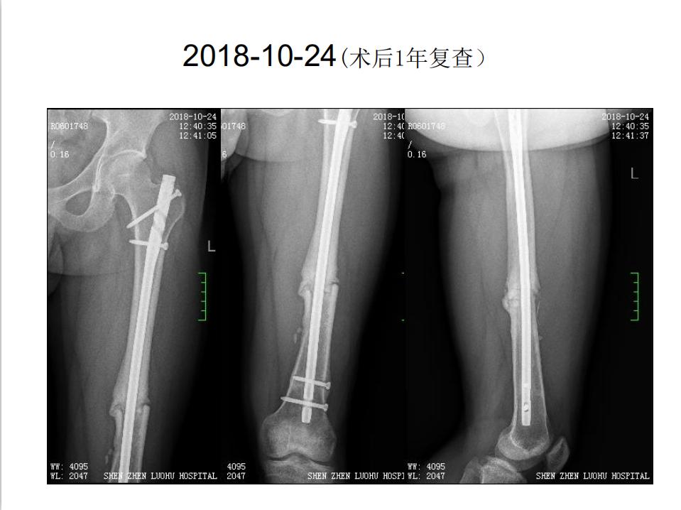 平乐骨科推拿教学,中医治疗骨折畸形愈合