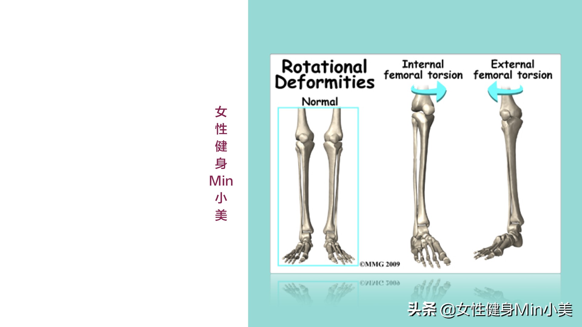 假胯宽大腿粗怎么办呢,假胯宽和大腿粗怎么办