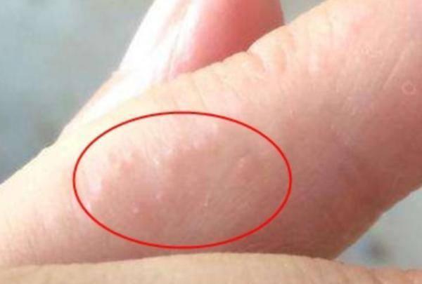 4个习惯加重体内湿气尽早改掉,手上全是小水泡如何祛湿