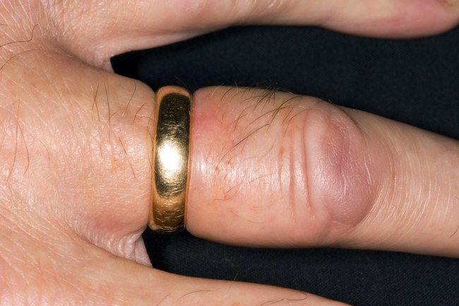 手指头肿了需要去医院吗,单个手指头肿胀要警惕四种病