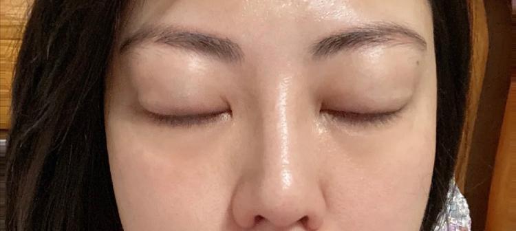 甲亢案例,甲亢治愈后眼球突自救方法