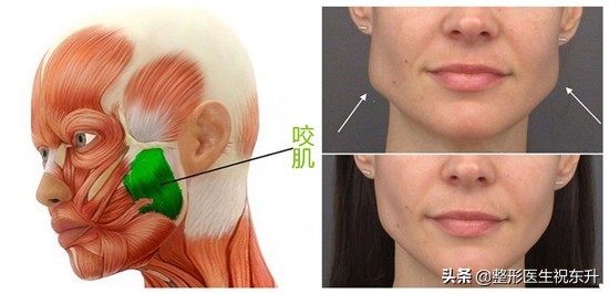 打瘦脸针的亲身经历,打了瘦脸针一年后图片详细记录