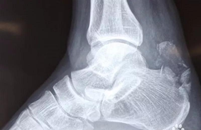 跟腱断裂术后康复训练,跟腱断裂恢复的小偏方