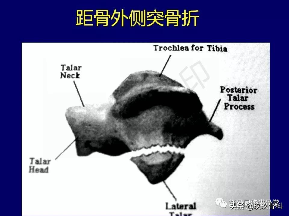 距骨骨折的治疗原则,距骨骨折如何调理