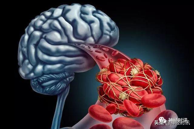 卒中静脉溶栓时间窗有望扩大到11小时？