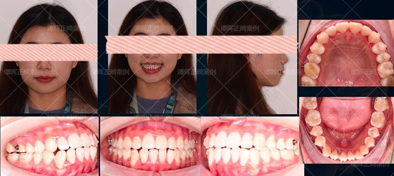 隐适美不拔牙矫正嘴凸,隐适美拔牙矫正三个月有效果吗