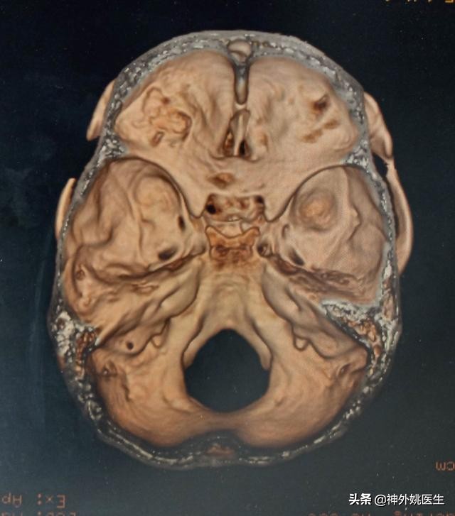 脑膜瘤是什么原因引起的啊,脑膜瘤手术治疗全部大概多少钱