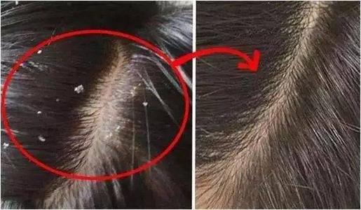 用康王洗头还有头屑怎么办,每隔一天洗头头皮痒有头屑