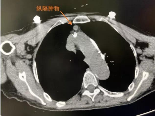 胸腔里待了5年的肿瘤，1小时摘除