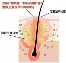 痘痘小问题,痘痘问题肌肤