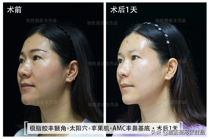 自体脂肪除皱是怎么样的,自体脂肪除皱的优点缺点有哪些