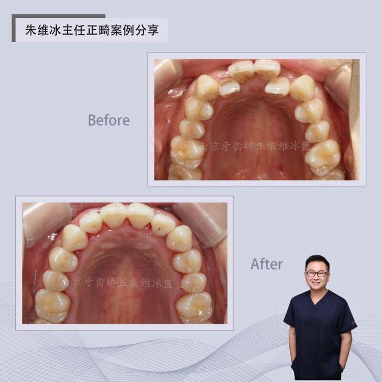 南京正畸朱维冰怎么样,南京牙齿正畸矫正技术