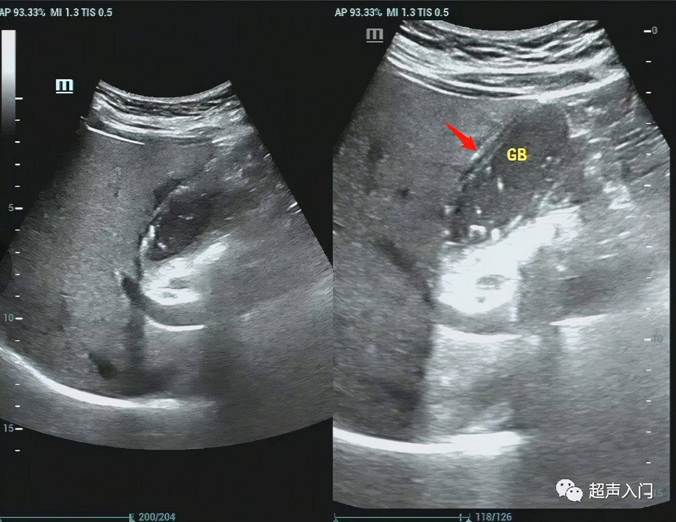 急性胆囊炎超声表现入门教学视频,急性胆囊炎超声诊断怎么写