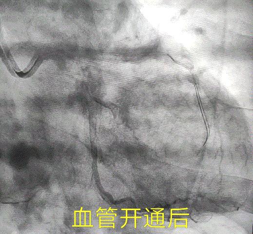 嗓子冒烟咳嗽很长时间也不好,嗓子冒烟儿