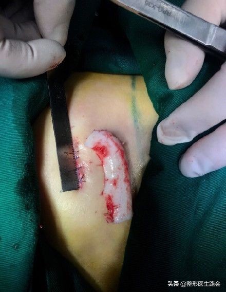 鼻整形手术风险,鼻整形副作用