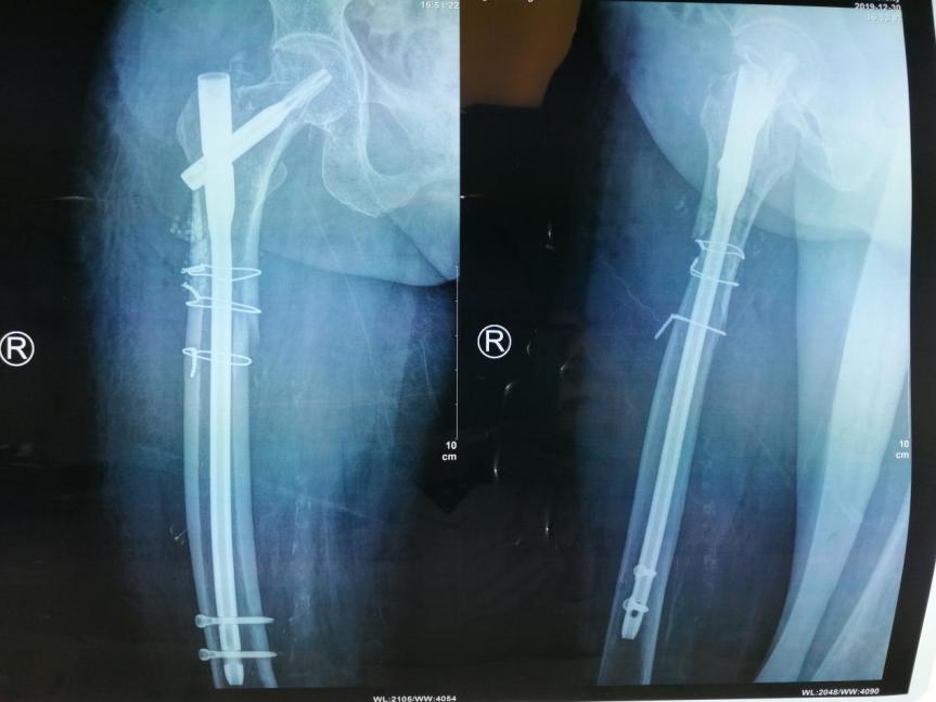 为什么说伤筋动骨一百天,都说伤筋动骨一百天是啥意思