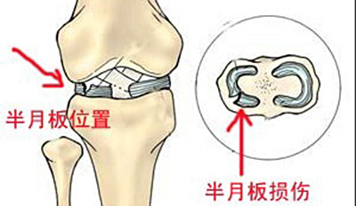 老年关节炎不能吃豆制品吗,氨基葡萄糖对膝关节软骨有用吗