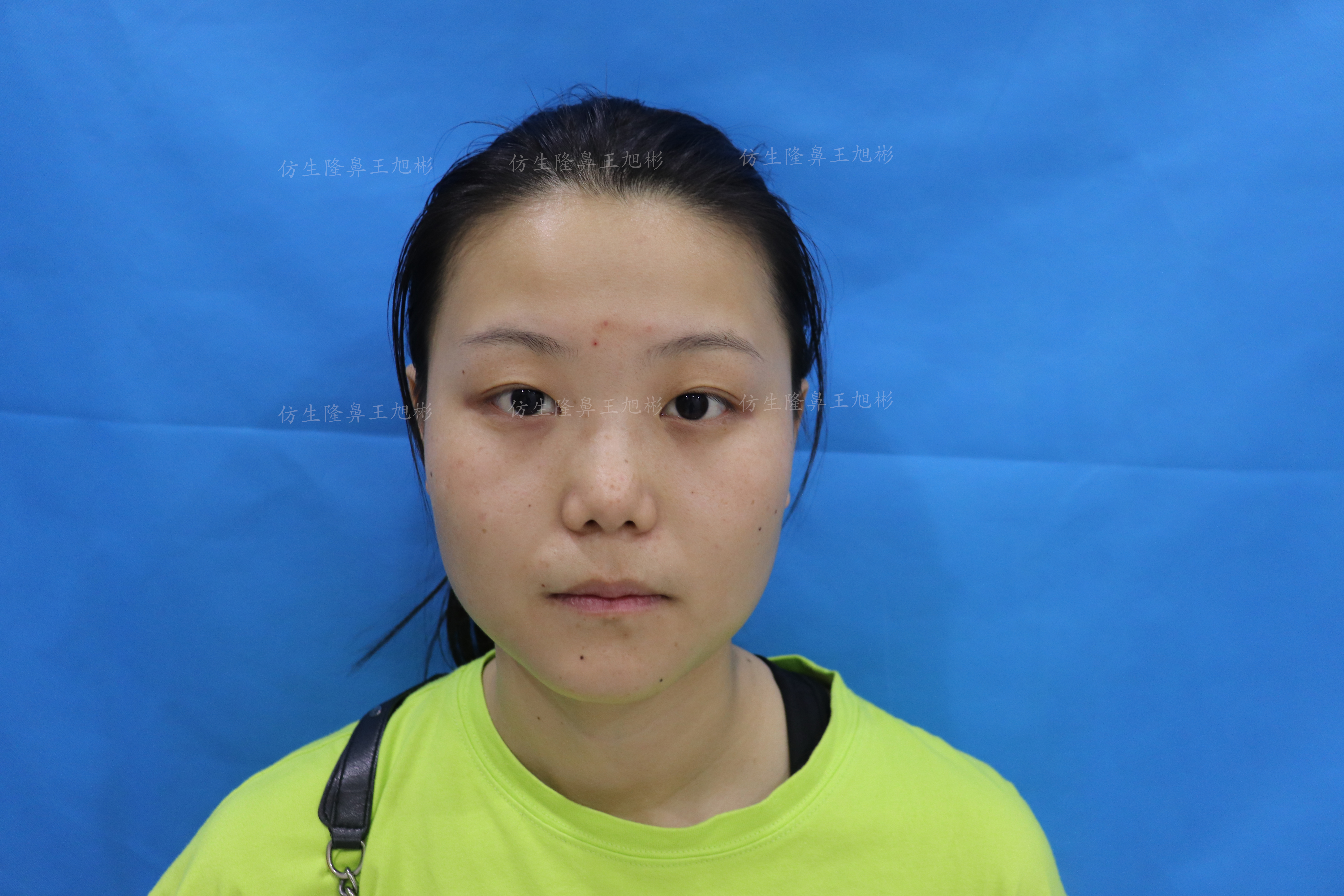 五官扁平的大饼脸,大饼脸和扁平五官怎样自救