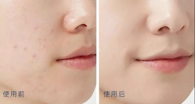 排痘效果好的药膏,祛痘排雷