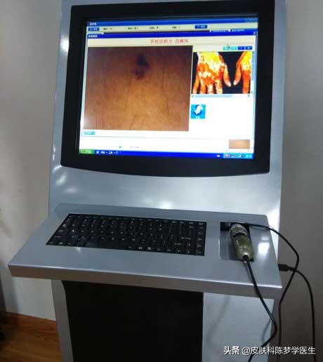 激光点痣为啥痣大了,颠覆你认知的祛斑方式