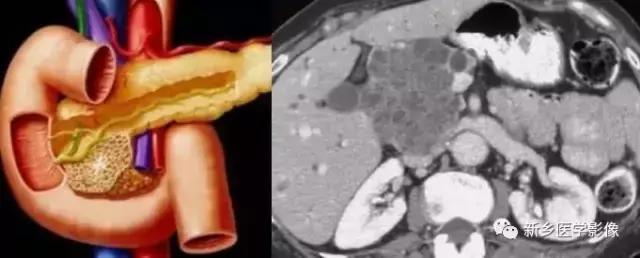18种胰腺肿瘤，为什么我就知道两种