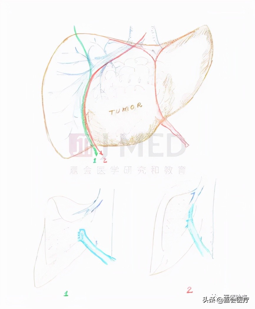 7mmx5mm肝癌能治愈吗,巨大型肝癌的治疗方法