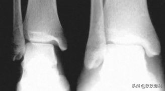 陈旧性踝关节损伤的治疗,踝关节损伤现场处理视频