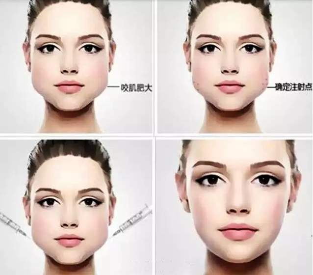 打瘦脸针真的会垮吗,打瘦脸针真的会垮脸吗
