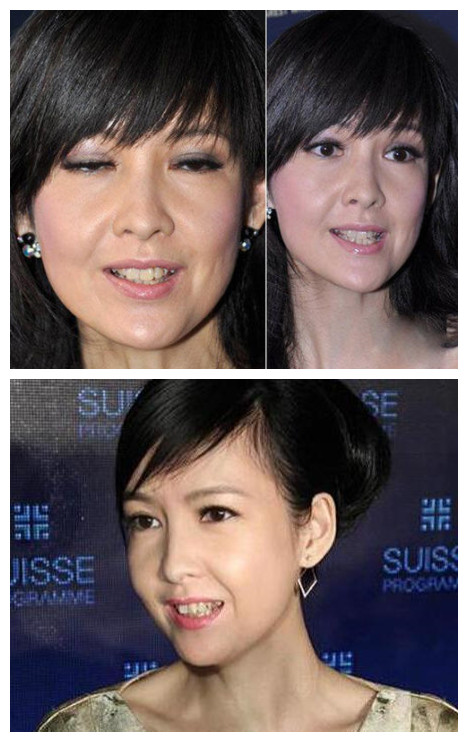 吴宣仪烤瓷牙怎么做,吴宣仪的整牙前