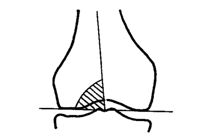 膝关节x线片可以查出啥,膝关节间隙x线测量方法