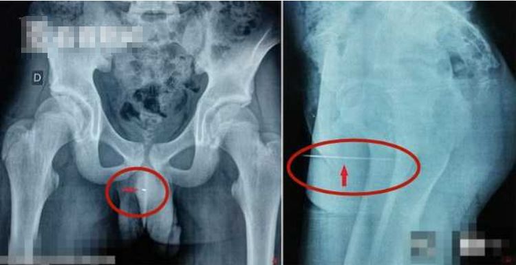 14岁男生把9厘米缝衣针插入尿道,痛苦三天去就医,网友:爽吗?