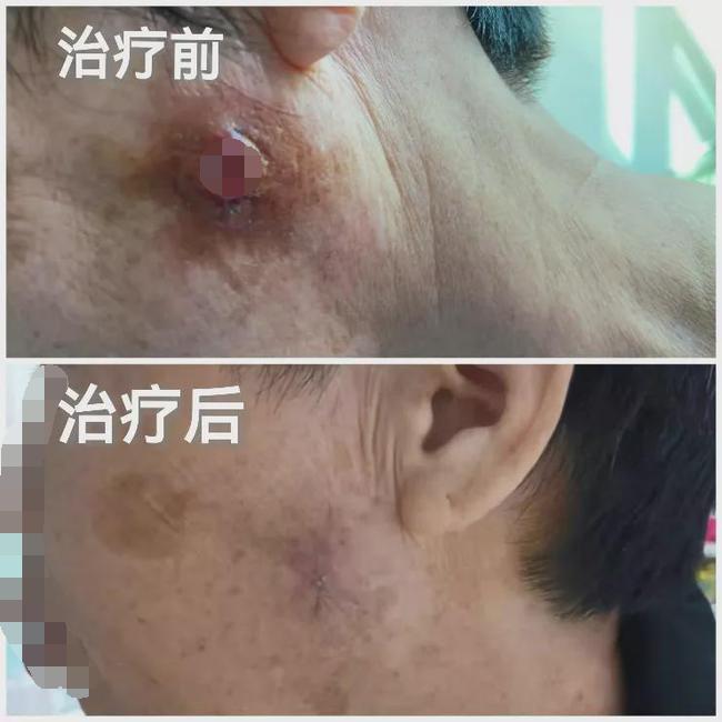 表皮小肿物,体表肿物恶性的几率大吗