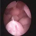 日照市人民医院微课堂——不容忽视的“子宫内膜息肉”