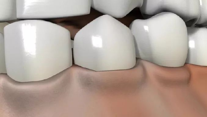 多图直击！牙医如何用抛光把孩子的牙洗干净？#葉子口腔科普#