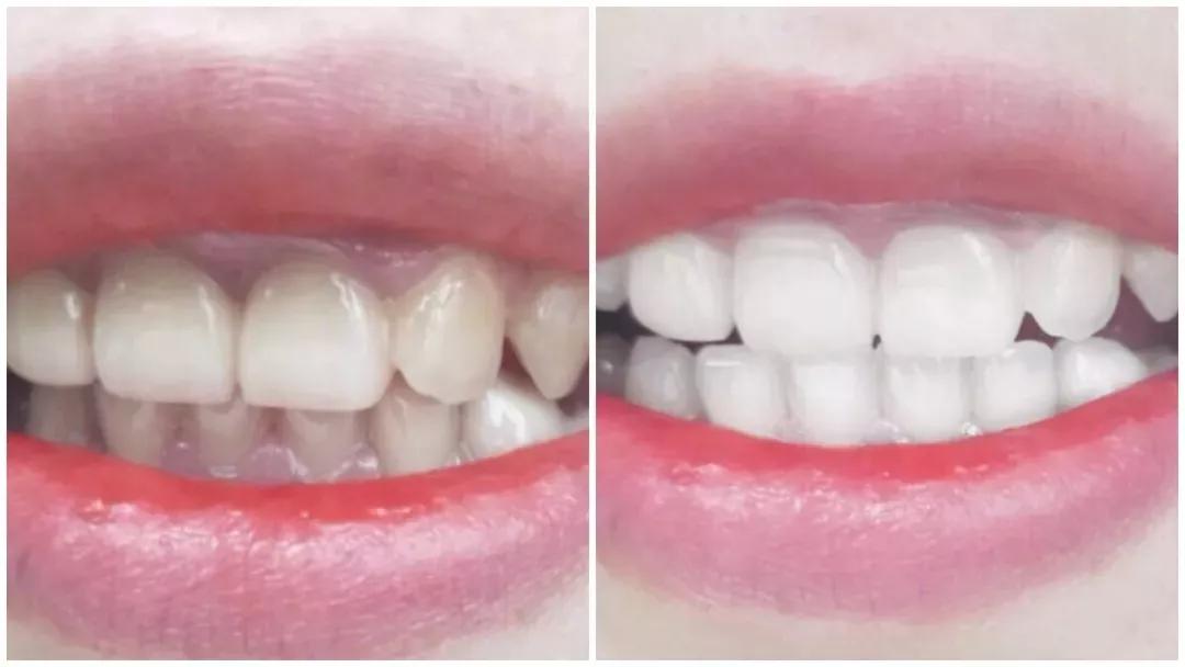 一张嘴就闻到牙臭味怎么办,一张嘴就恶臭怎么回事