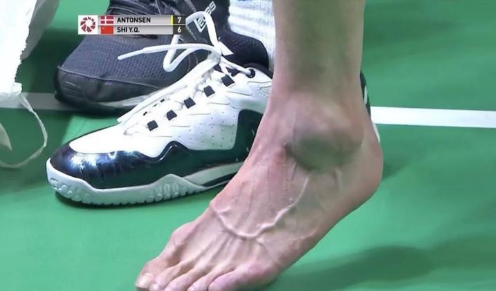 石宇奇最新伤情:自曝骨头无碍韧带撕裂大概率将无缘世锦赛