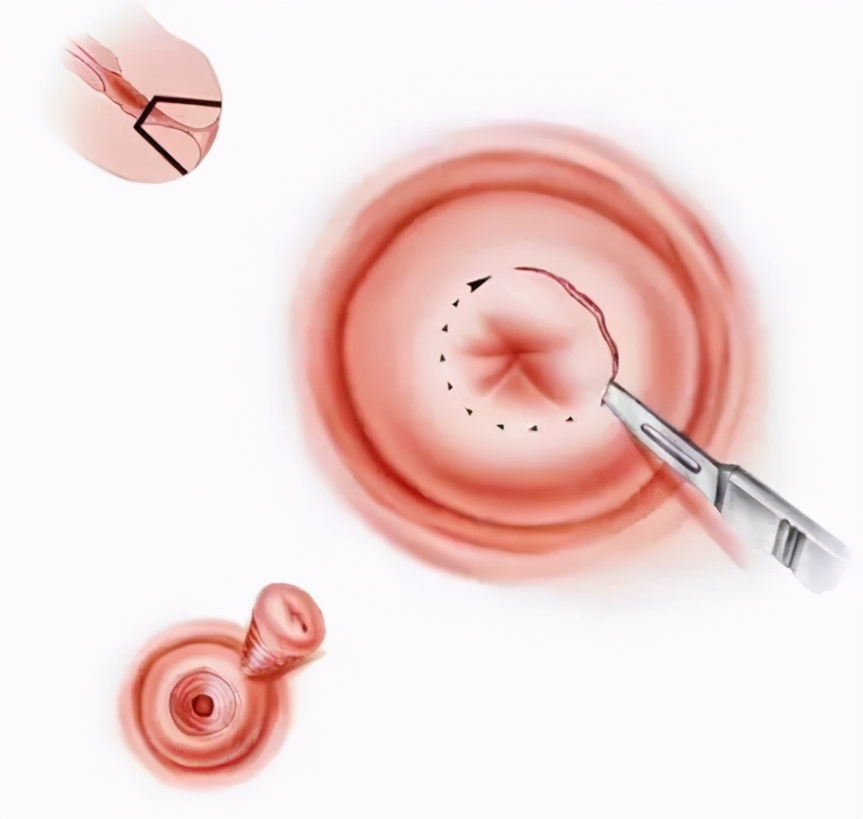 宫颈浸润癌可以保留生育能力吗,宫颈癌保留生育功能的患者