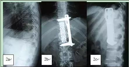 脊柱结核是怎么回事,健康科普不该被忽视的脊柱结核