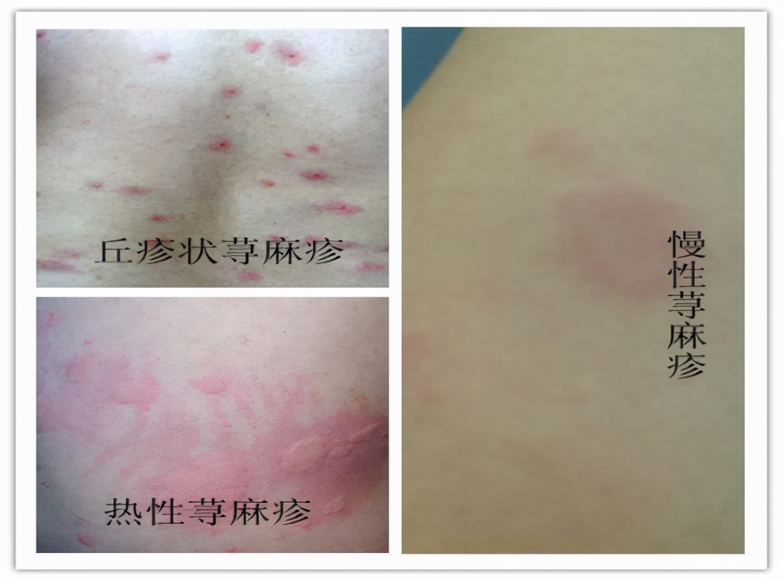 荨麻疹缓解瘙痒的方法是什么,荨麻疹瘙痒难忍可以用什么缓解