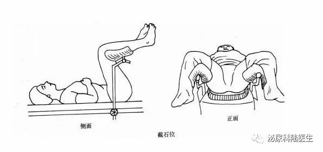 科普|老年女性百分百成功导尿秘笈来喽