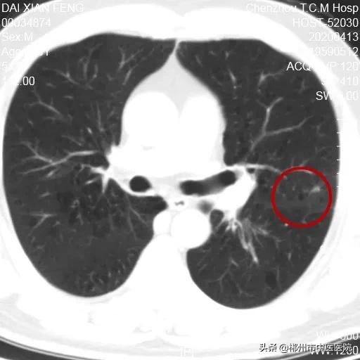 肺癌陀螺刀放疗后五年生存率,得了肺癌是不是不要轻易动手术