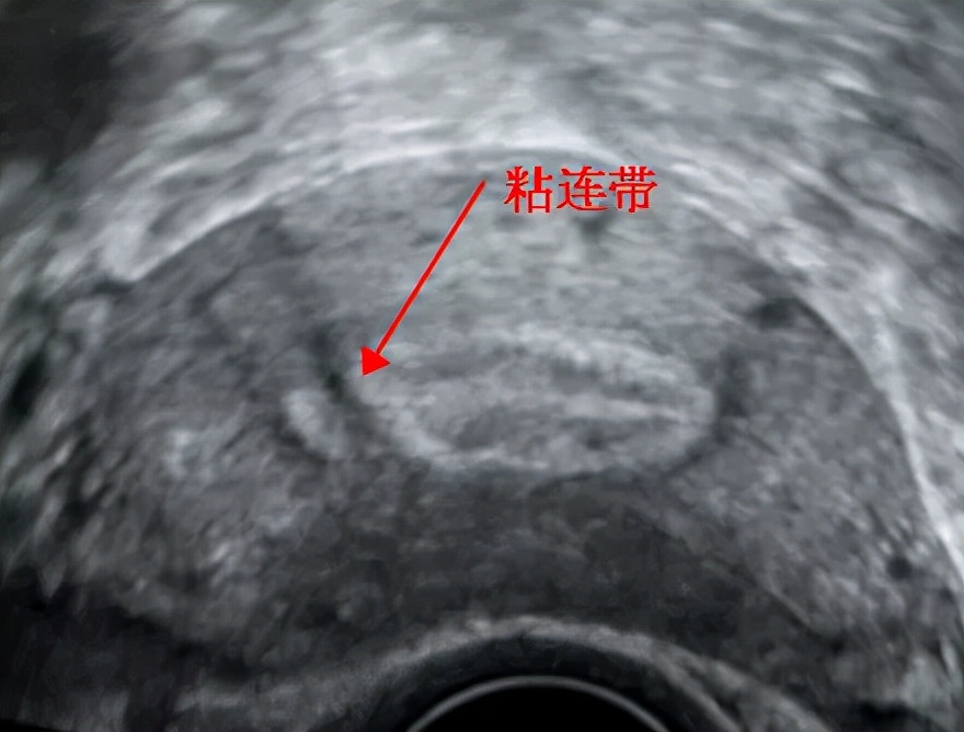 四维超声能看出宫腔粘连吗,做超声能看出来宫腔粘连吗